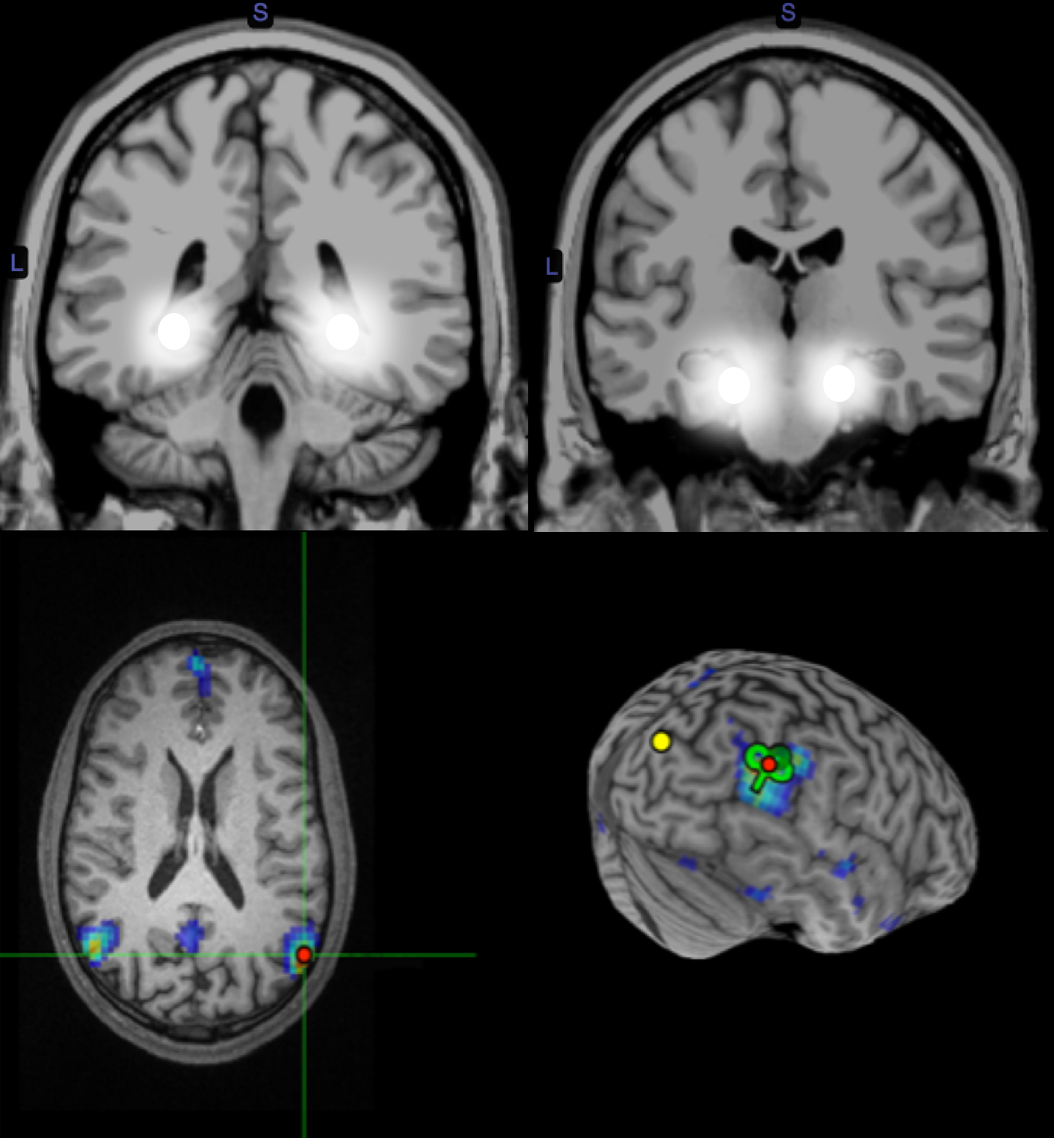 brain scan